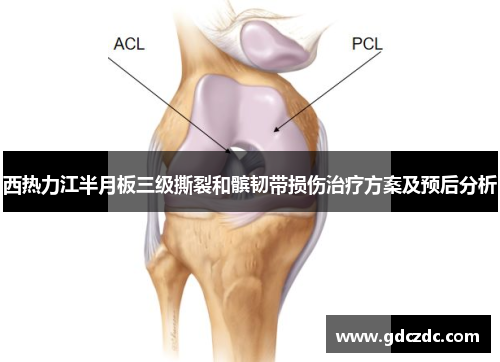 西热力江半月板三级撕裂和髌韧带损伤治疗方案及预后分析